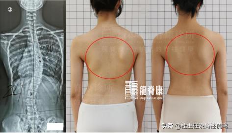 儿童脊柱侧弯单杠矫正正确姿势,脊柱侧弯拉单杠好还是吊单杠好