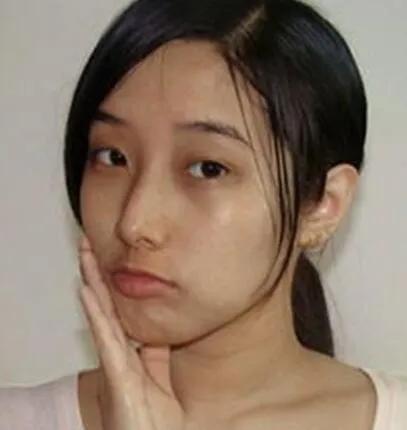 褐青色斑治疗最佳时间,褐青斑有哪些症状