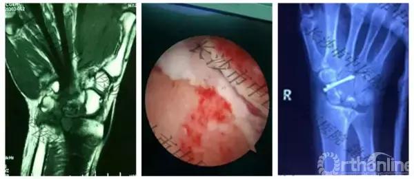 腱鞘囊肿除了手术还有什么办法,下颚有囊肿可以做穿刺手术