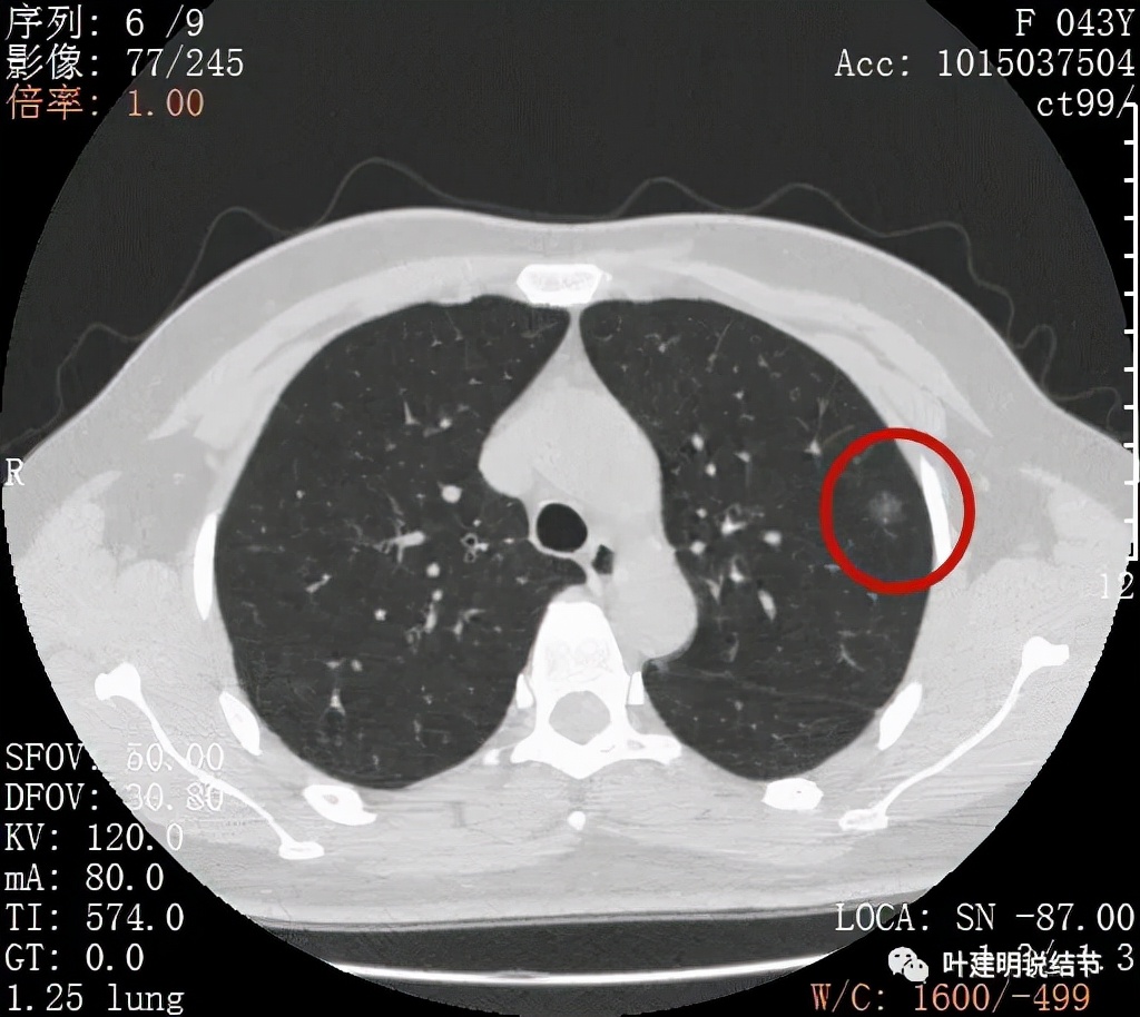 从活检怎么看是非小细胞癌,从病例谈辨证论治
