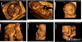 B超三维和四维彩超的区别,三维b超跟四维彩超的区别