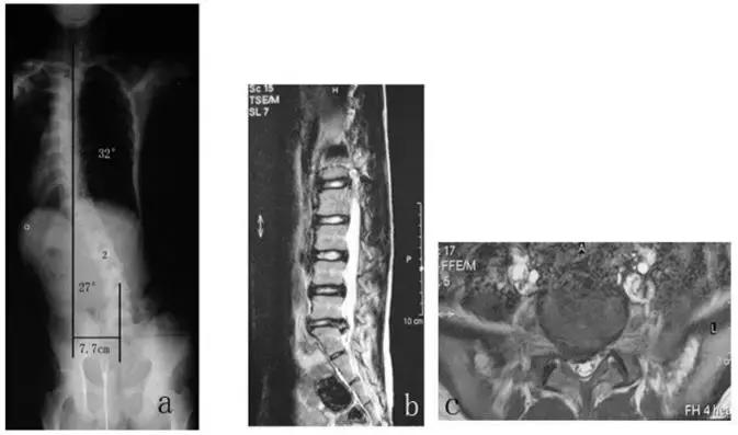 腰突脊柱侧弯最好的恢复方法,腰突为什么会引起侧弯