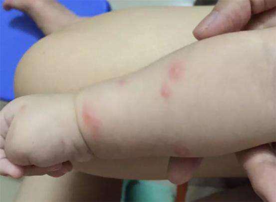 夏天蚊虫多给宝宝们备起来,夏季外出宝宝防蚊虫最有效