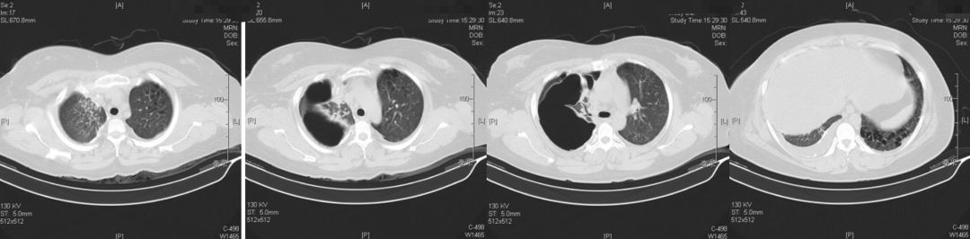女性气胸的十大症状,女性气胸的十个表现