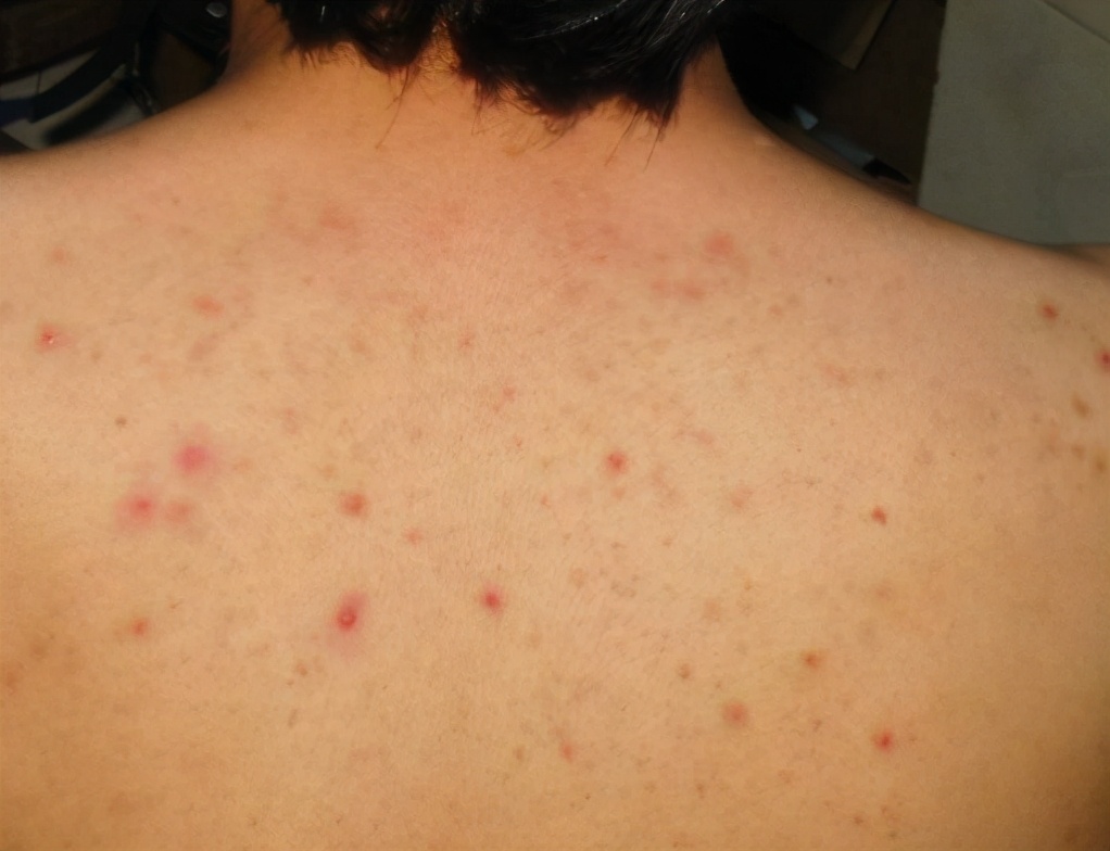 毛囊炎最好的内服药排名,有治疗毛囊炎的特效药吗