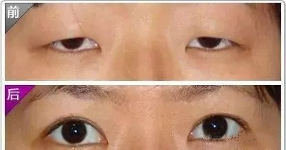开眼角真的能变漂亮吗,关于开眼角你都了解什么