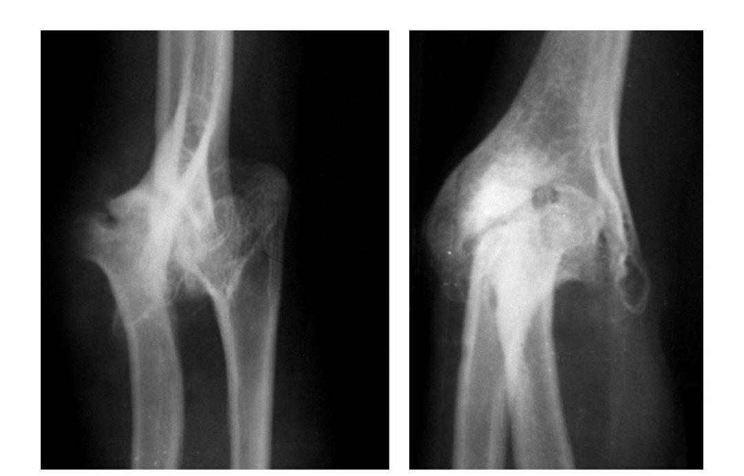 青少年肘部损伤最常见的是,肘部桡神经损伤的临床表现
