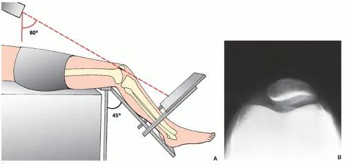 膝盖髌骨上下楼梯疼痛怎么办,髌骨外倾可以矫正过来吗