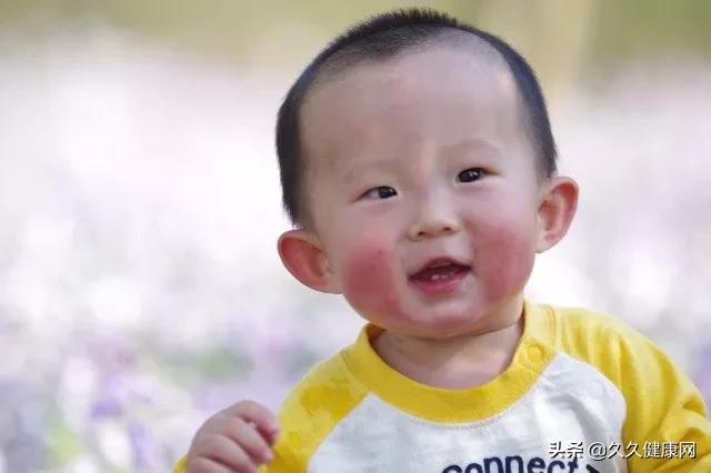 宝宝红脸蛋是食火吗,宝宝红脸蛋是因为角质层受损了吗