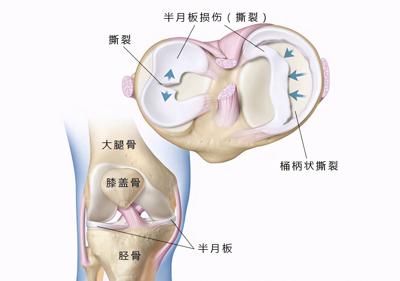半月板撕裂中医骨科,半月板撕裂挂骨科还是骨伤科