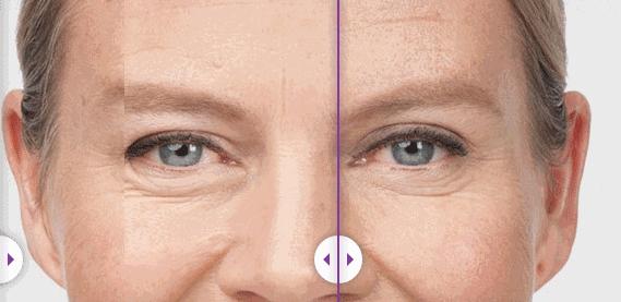 眼膜学生党去黑眼圈男生,眼膜男用