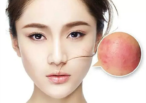 脸上泛红敏感肌肤的注意事项,敏感肌肤泛红怎么改善