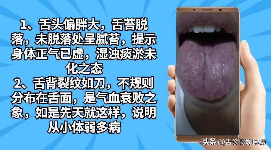 罗大伦舌诊图解肝郁气滞的舌象,抖音舌诊看体质