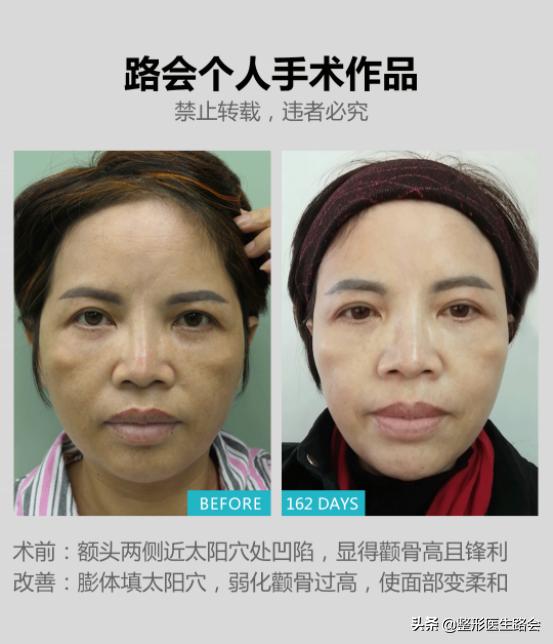 假体材料都有哪几种,假体材料都有什么