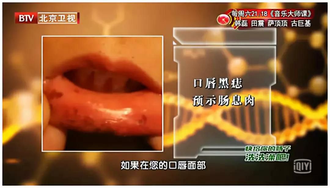 肠癌出现症状往往就是晚期吗,为什么肠癌一发现就是晚期