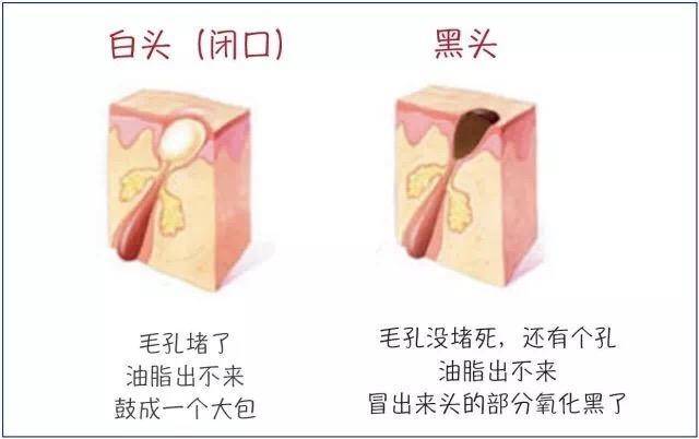 去黑头完了如何修复,去黑头省钱攻略