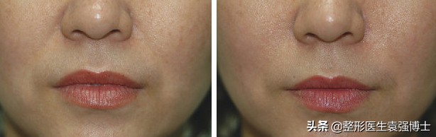 什么治法令纹最有效,天生就有法令纹去除不了吗