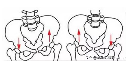 高低胯引起的长短腿,高低肩长短腿容易发生什么病