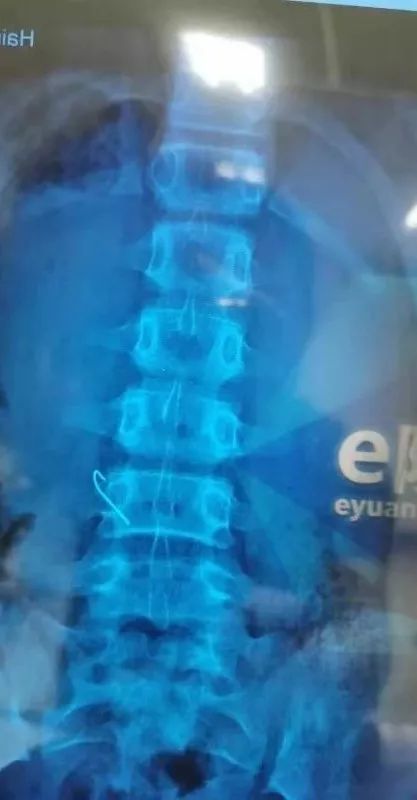 鱼钩剔牙!儋州12岁女孩误吞鱼钩,到院钩子已滑落到十二指肠…