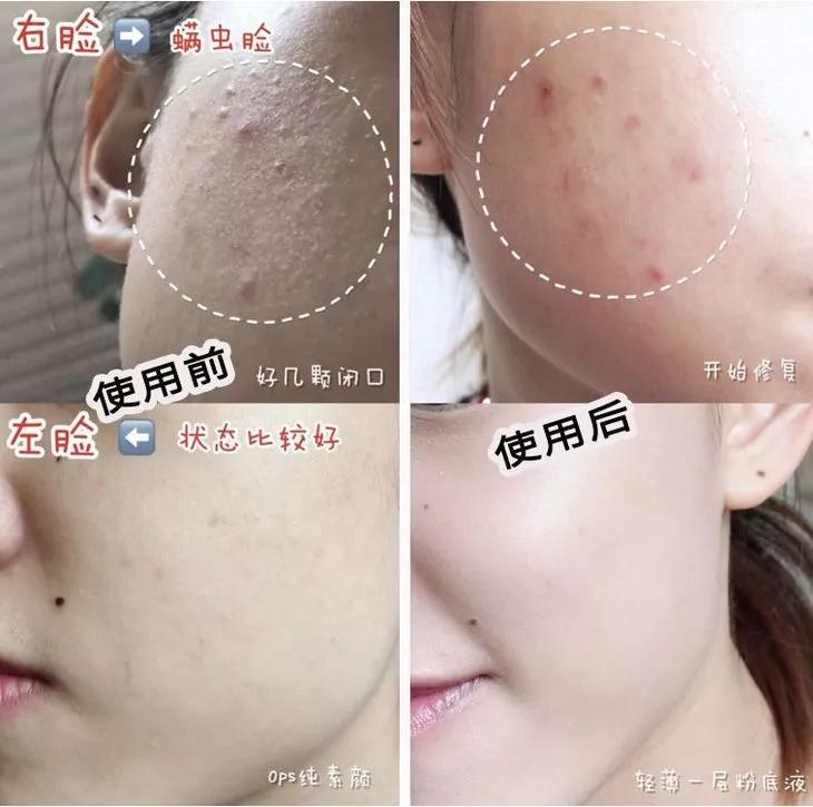 专治螨虫的洗面奶,螨虫专用洁面乳