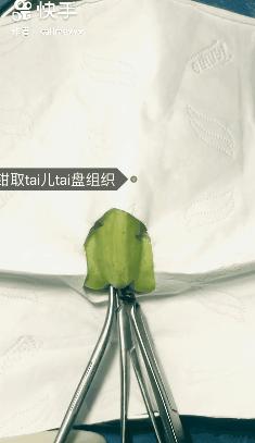 香蕉割包皮，洋葱剖腹产？这是我见过最秀的医生