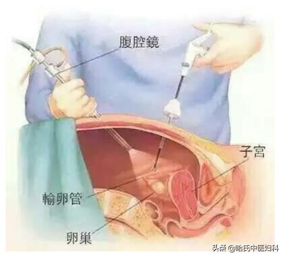29岁输卵管堵塞怀孕,结婚流产一回会输卵管堵吗