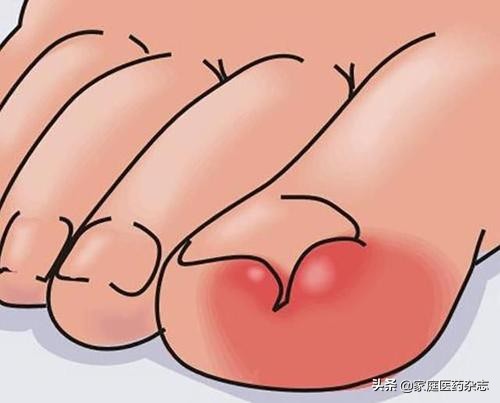 跑步后，脚趾甲变黑且伴有疼痛，是怎么回事？