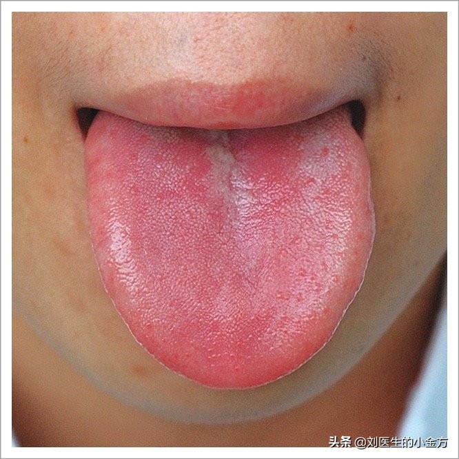 中医舌诊对照表100例,舌诊辨九大体质