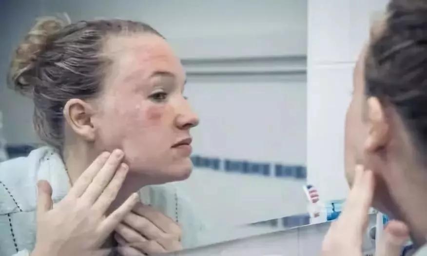 改善暗沉闭口粉刺敏感肌的水乳,如何拯救烂脸痘痘肌