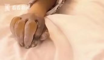 13岁女生扫雪冻伤手指险截肢,13岁女孩扫雪被冻伤后续