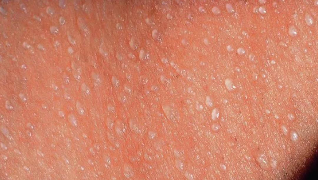 热痱子与汗疱疹的区别,汗疱疹和痱子的区别