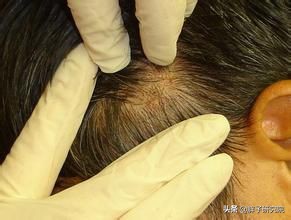 谈谈火“疖”子：毛囊炎的发病及日常护理