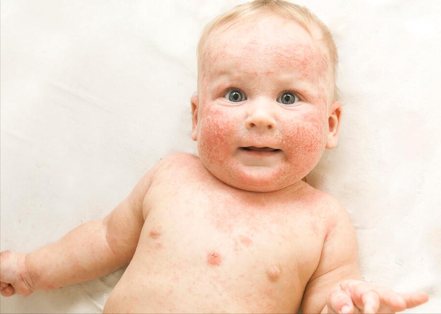 湿疹死皮粘着肉,湿疹粘在衣服上