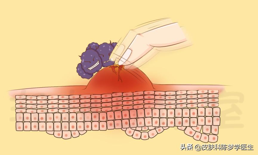 被蚊虫叮咬留下的“红包”怎么办?你可以选择这些药膏