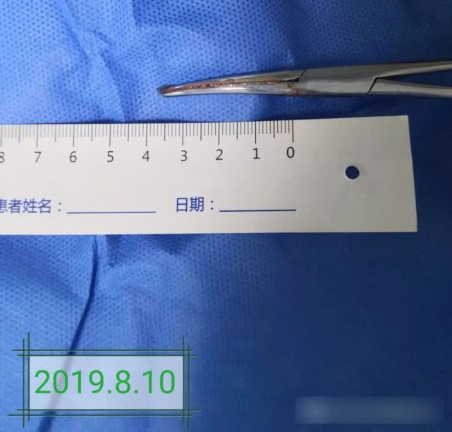 阑尾炎形成窦道的原因,阑尾炎一孔微创手术全过程