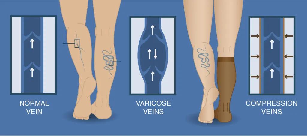 压力治疗的适应症有哪些,压力疗法的主要适应症是什么