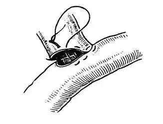 外科缝合方法笔记,兽医外科手术中最常用的缝合方法