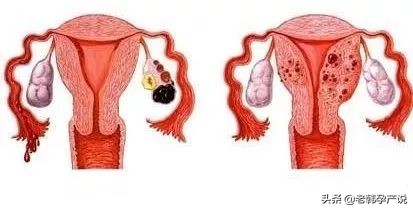 子宫内膜只有5mm的怀孕了怎么办,子宫内膜厚度20mm是怀孕多久了