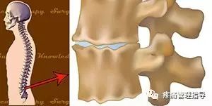 72岁老人腰疼还有骨刺该怎么治疗,老年人骨刺疼痛怎么治疗