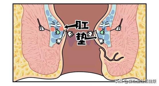 产后痔疮大便出血疼痛怎么办,直肠癌和痔疮大便出血的区别