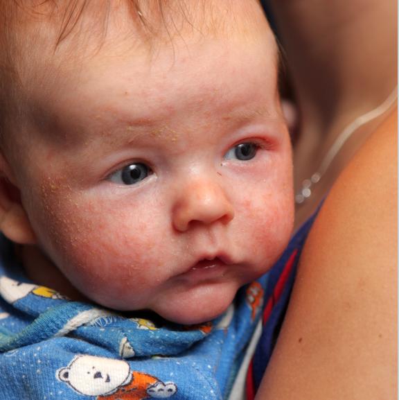 过敏性湿疹的病例,婴儿湿疹病例分享