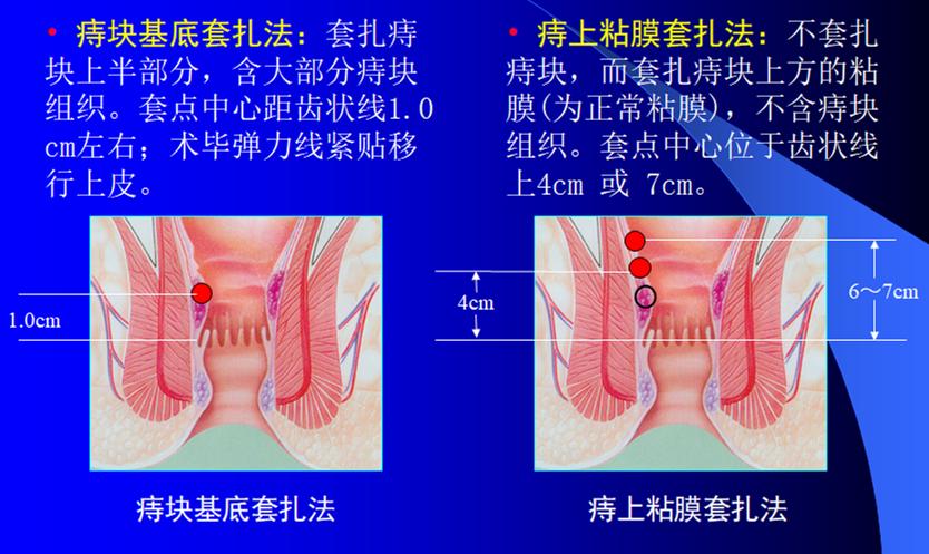 痔疮手术在线解答,痔病微创手术相关问题