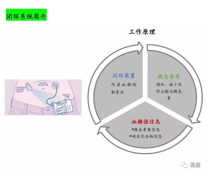 胰岛素泵闭环控糖效果,闭环胰岛素泵是什么意思