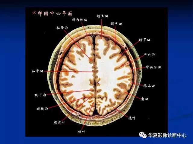 电子版头颅ct与mri断层解剖,头颅mri血管解剖与分段详解