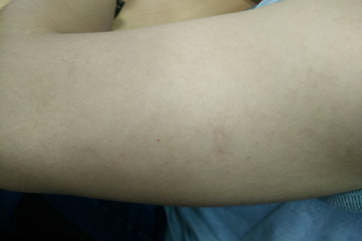 天气干燥皮屑多,天气干燥掉皮怎么办