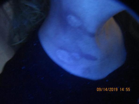 白癜风女子坚持抗复发,白癜风康复了的女孩