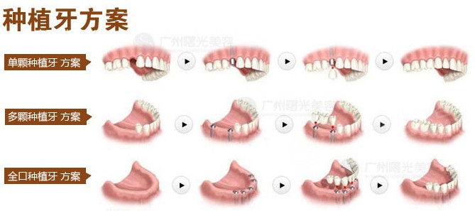 梁光强种植牙医生简介,杆卡式种植牙