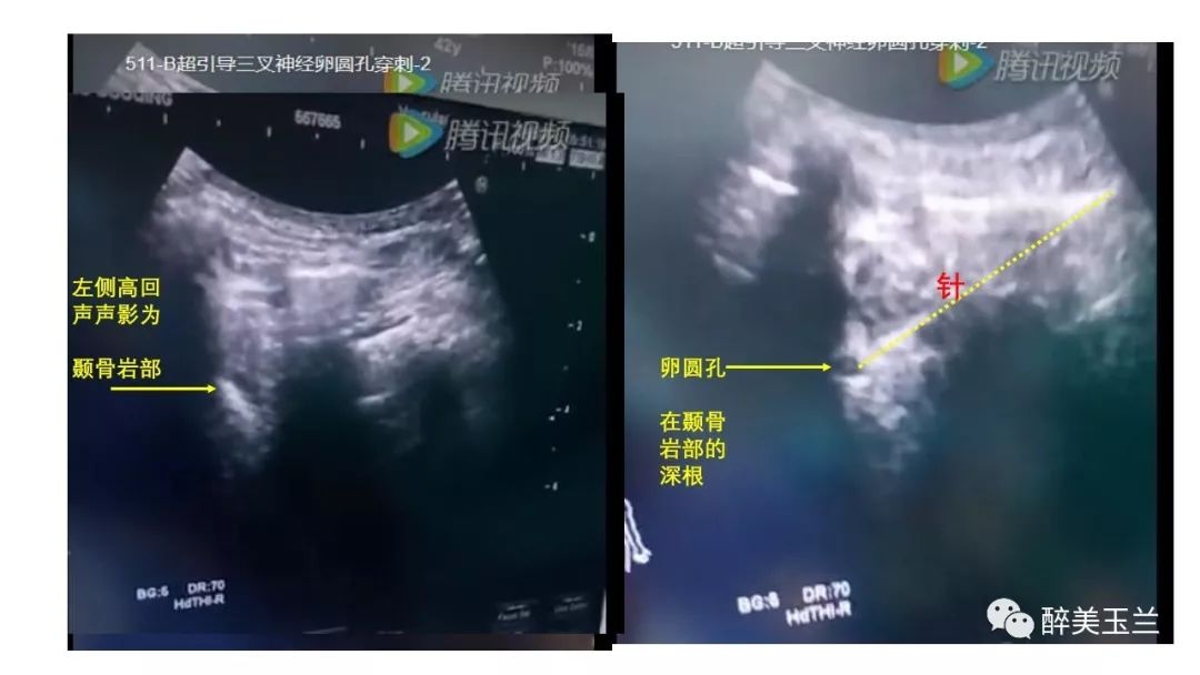 病例分享丨三叉神经节微球囊压迫术的麻醉管理