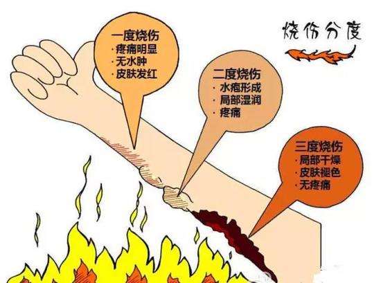 烧伤瘢痕你不知道的那些事