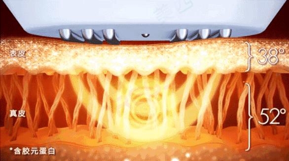 热玛吉超声刀光子嫩肤,超声炮热玛吉光子嫩肤的区别